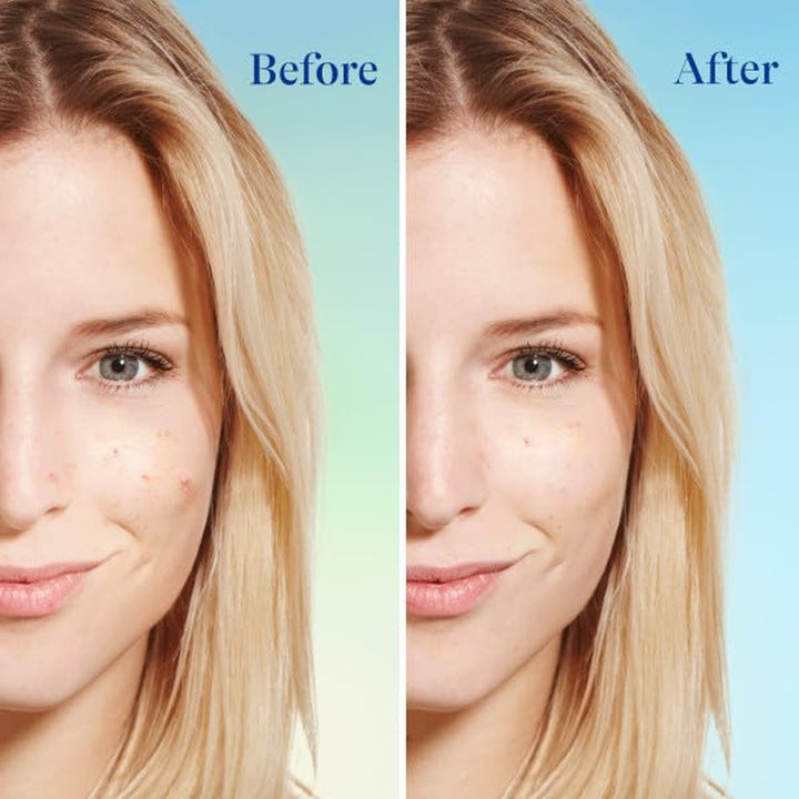 Acne Face Wash with 5% Benzoyl Peroxide
