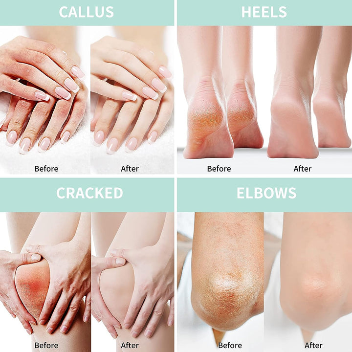 Urea Cream 40% for Feet & Callus Remover